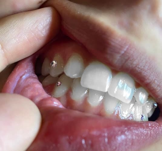 Hollywood Smiles409 Cosmetic Teeth Whitening in Beaumont, TX